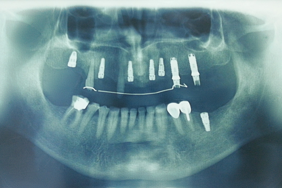 oralna-hirurgija-i-implantologija